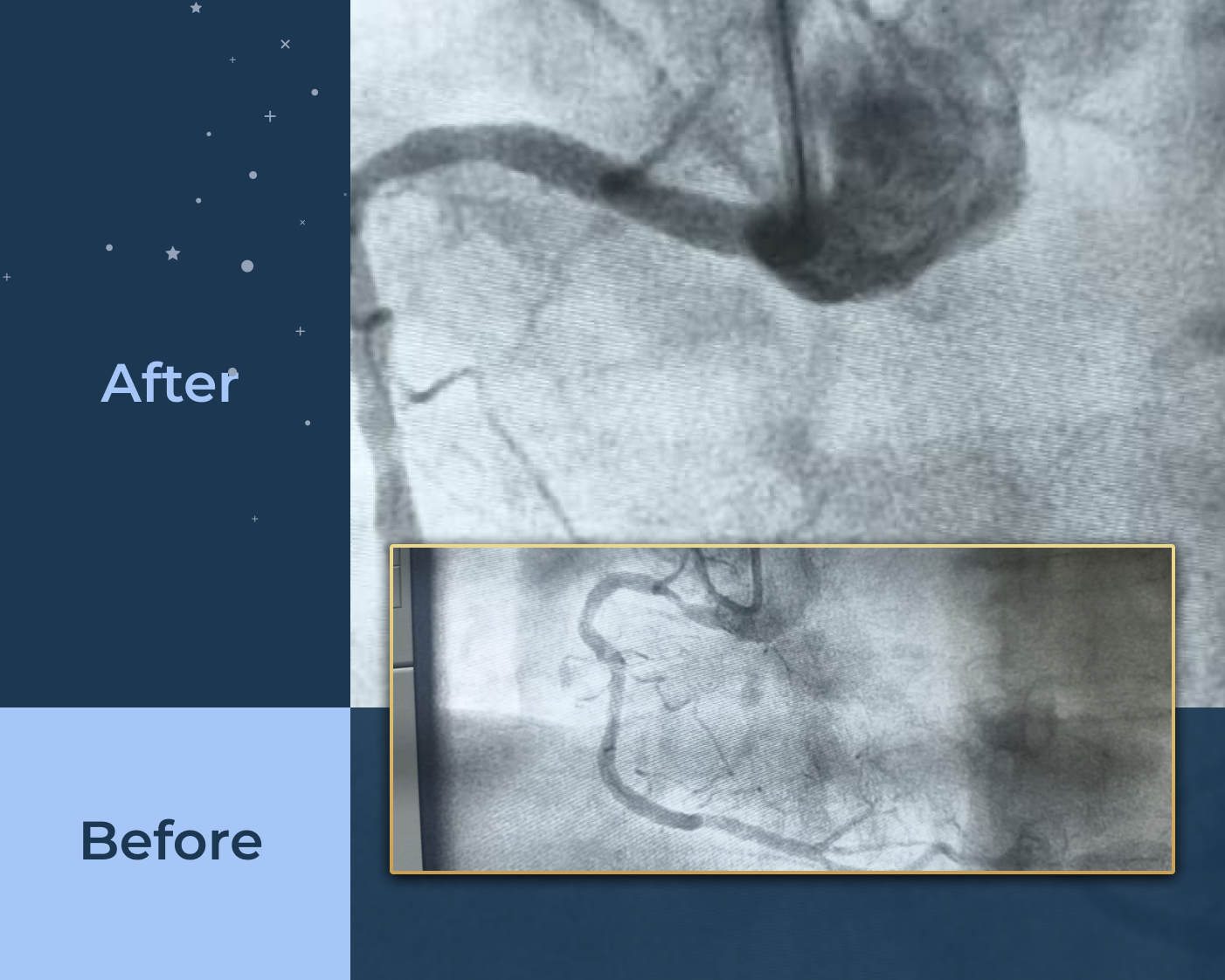 Renal-artery