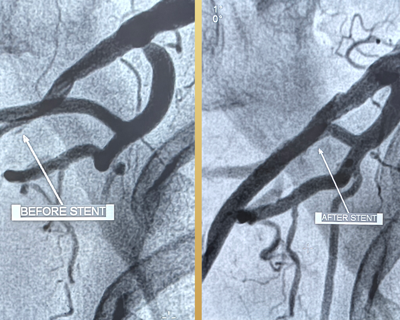 Peripheral-Arterial